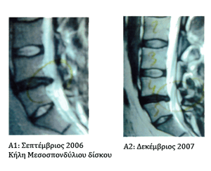 Μαγνητική τομογραφία θεραπείας κήλης μεσοσπονδύλιου δίσκου